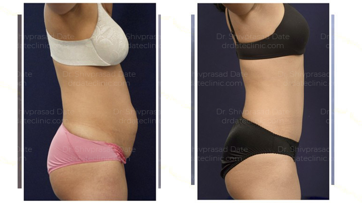 Liposuction Cost In Mumbai