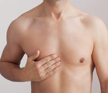Gynecomastia