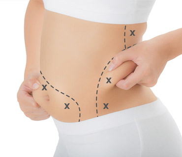 Liposuction