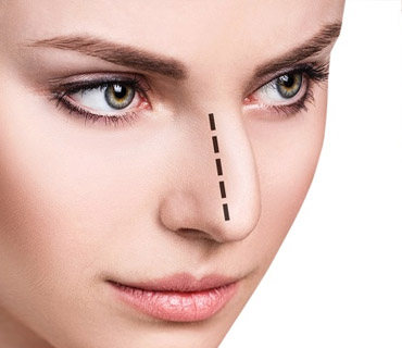 Rhinoplasty