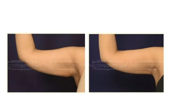 Before and after arm lift — case 1