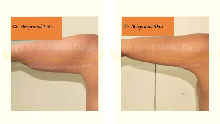 Before and after arm lift — case 2