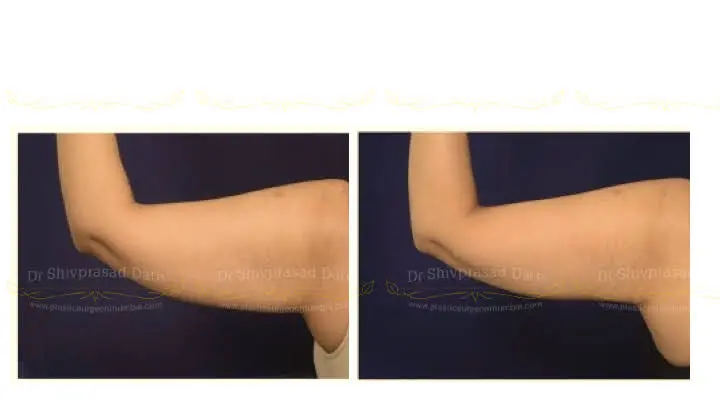 Before and after arm lift — case 3