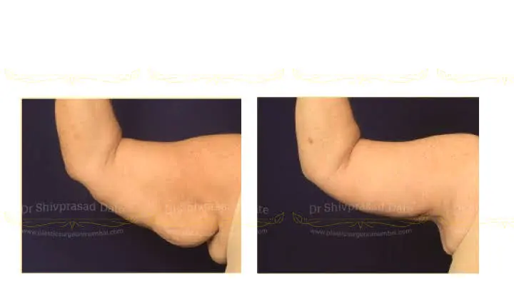 Before and after arm lift — case 4