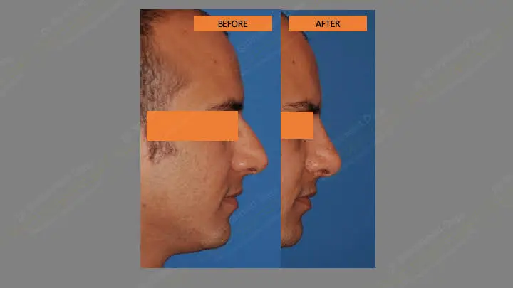 Before and after rhinoplasty — case 1