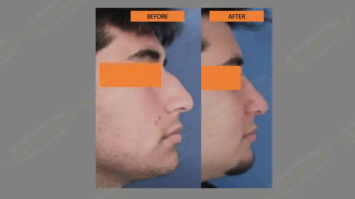 Before and after rhinoplasty — case 2