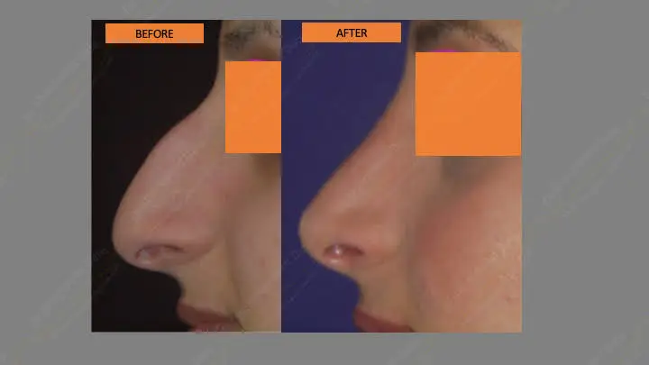 Before and after rhinoplasty — case 3