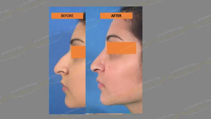 Before and after rhinoplasty — case 4