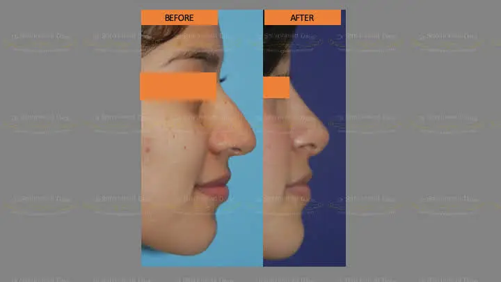 Before and after rhinoplasty — case 5