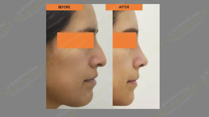 Before and after rhinoplasty — case 6