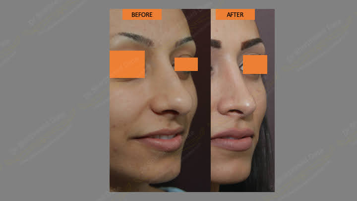 Before and after rhinoplasty — case 7