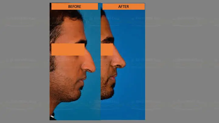 Before and after rhinoplasty — case 8