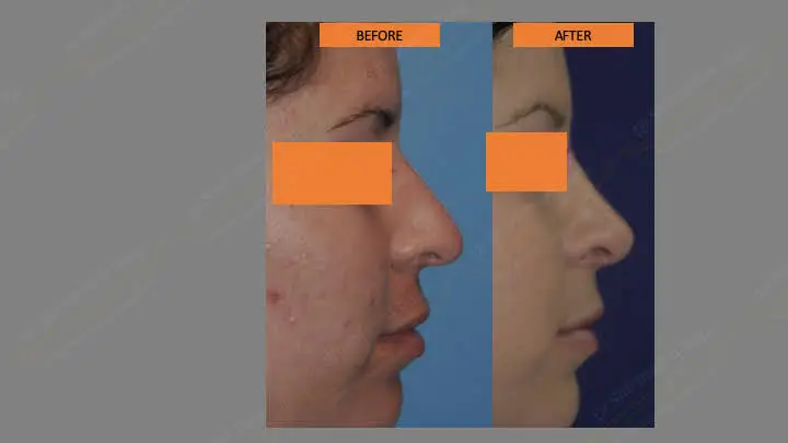 Before and after rhinoplasty — case 9