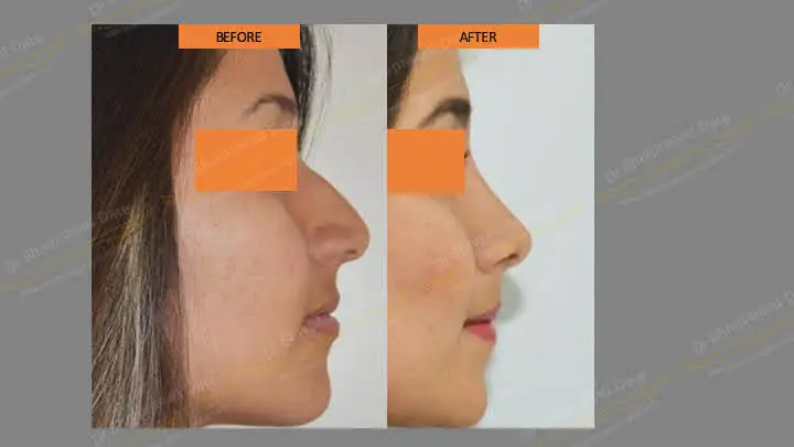 Before and after rhinoplasty — case 10