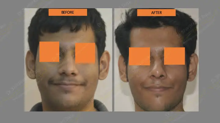 Before and after rhinoplasty — case 11
