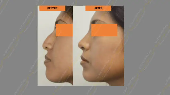 Before and after rhinoplasty — case 12