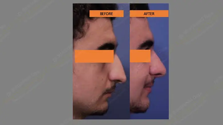 Before and after rhinoplasty — case 13