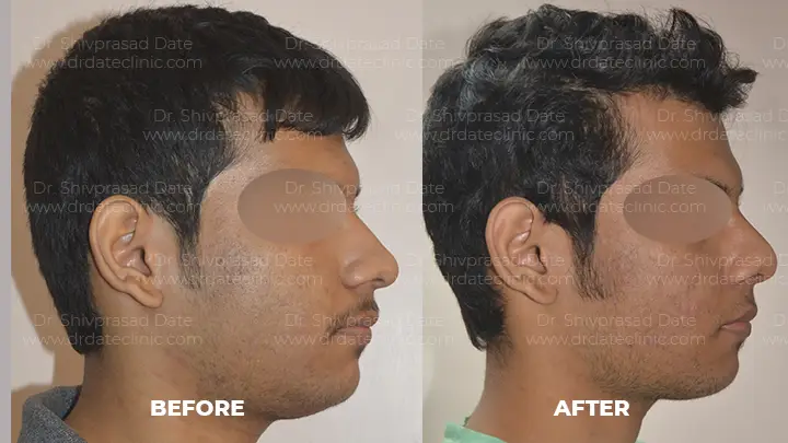 Before and after rhinoplasty — case 14
