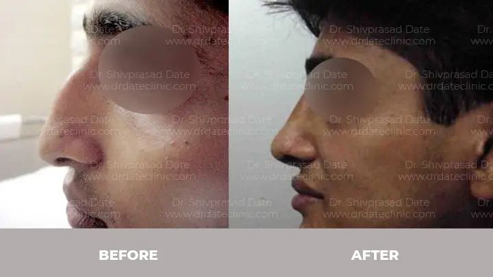 Before and after rhinoplasty — case 15