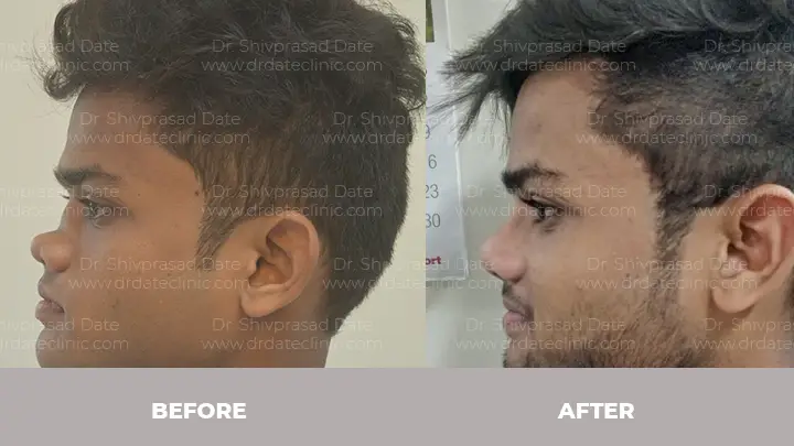 Before and after rhinoplasty — case 16