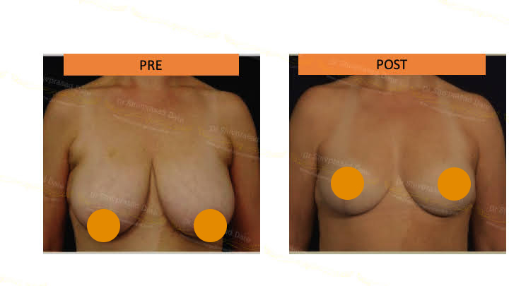 Before and after breast lift — case 1