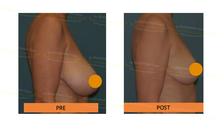 Before and after breast lift — case 2