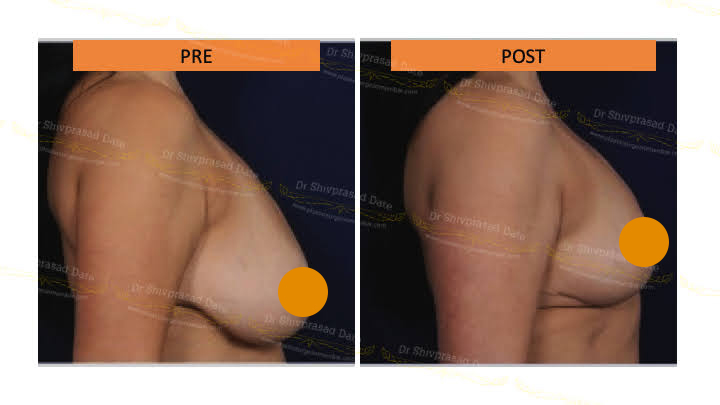 Before and after breast lift — case 3