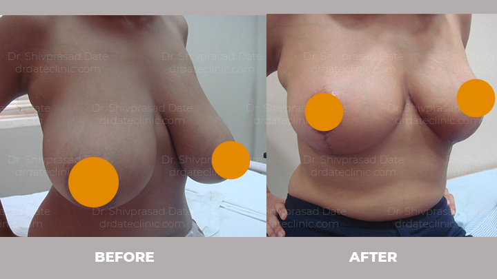 Before and after breast lift — case 4