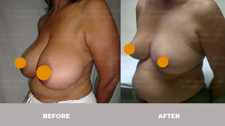Before and after breast lift — case 5