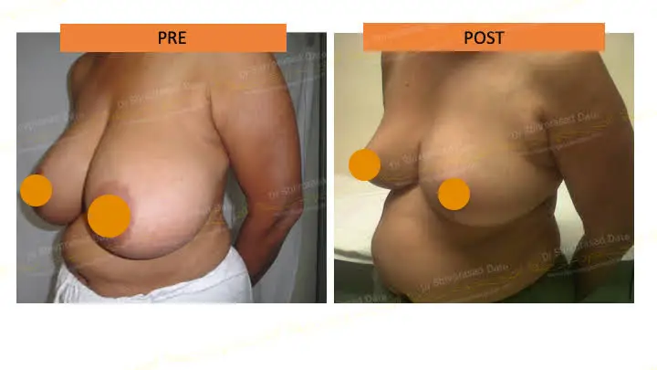 Before and after breast reduction surgery cost — case 2