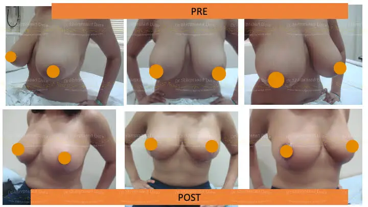 Before and after breast reduction surgery cost — case 3