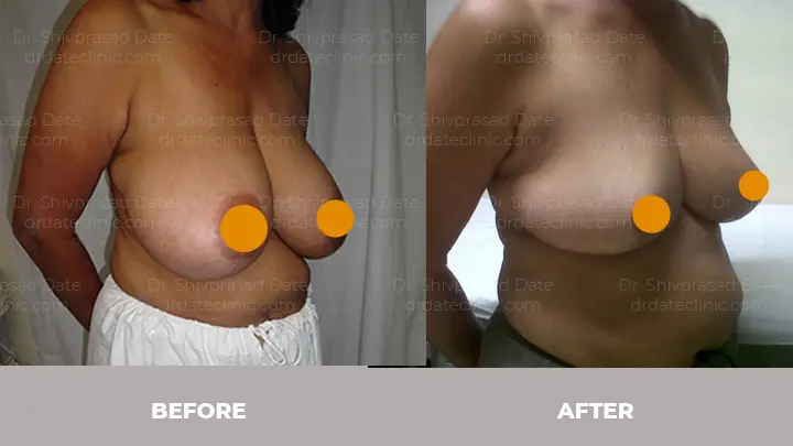 Before and after breast reduction surgery cost — case 6