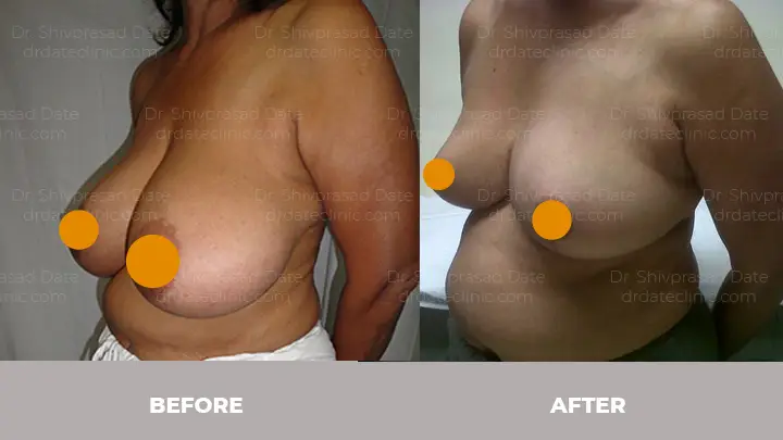 Before and after breast reduction surgery cost — case 7