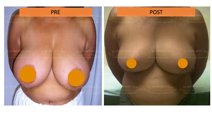 Before and after breast reduction — case 1
