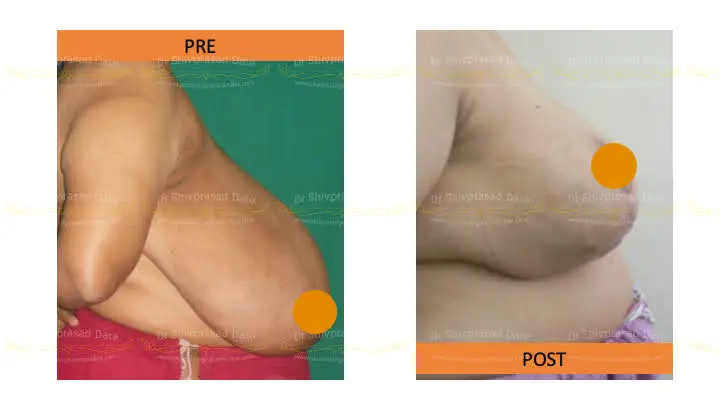 Before and after breast reduction — case 4