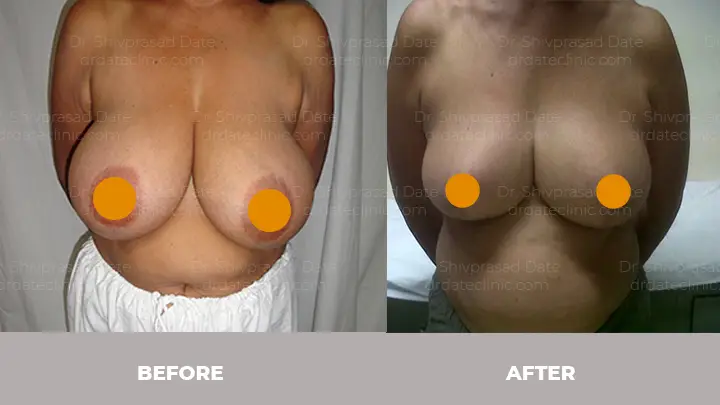 Before and after breast reduction — case 5