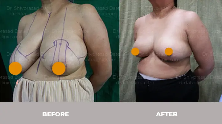 Before and after breast reduction — case 8