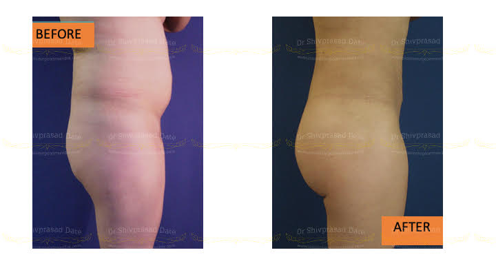 Before and after butt lift — case 1