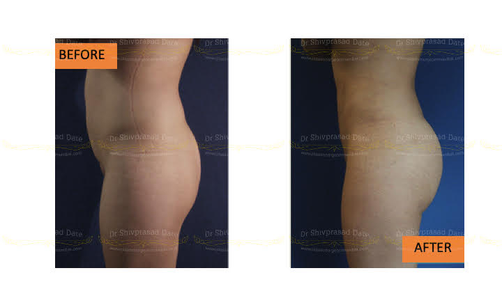 Before and after butt lift — case 2
