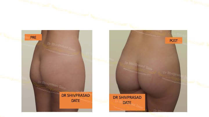 Before and after butt lift — case 3