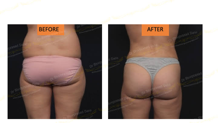 Before and after butt lift — case 5