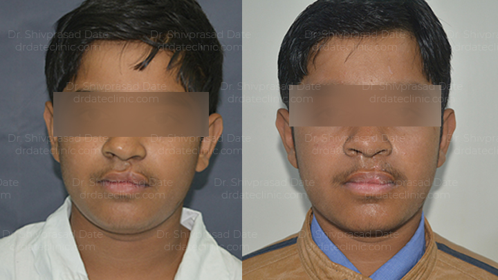 Before and after cleft lip plate reconstruction — case 1