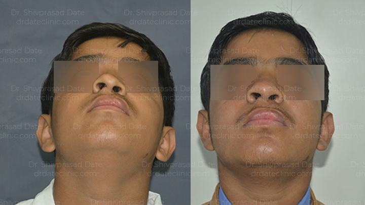 Before and after cleft lip plate reconstruction — case 2