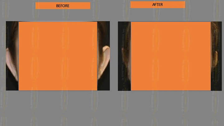 Before and after ear reconstruction cost — case 5