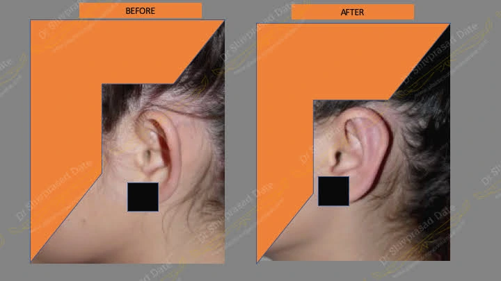 Before and after ear reconstruction cost — case 1