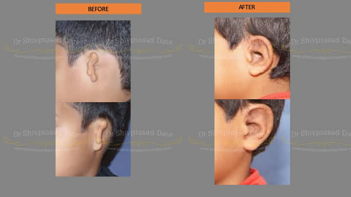 Before and after ear reconstruction cost — case 2