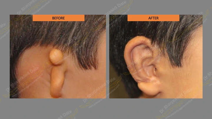 Before and after ear reconstruction cost — case 3