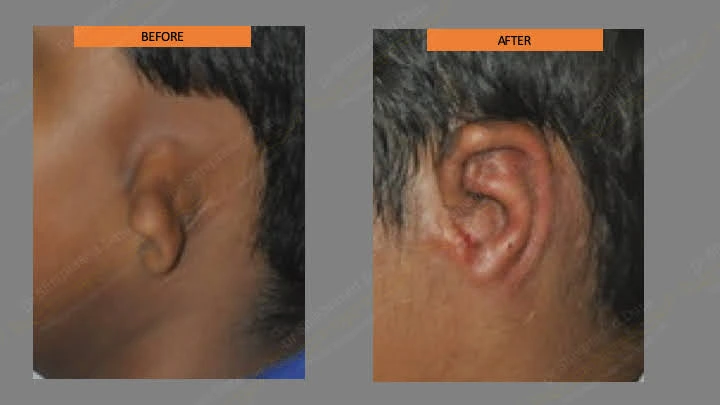 Before and after ear reconstruction cost — case 6