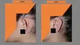 Before and after ear reconstruction cost — case 7