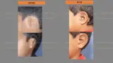 Before and after ear reconstruction cost — case 8